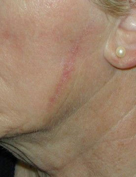 Laser scar treatment